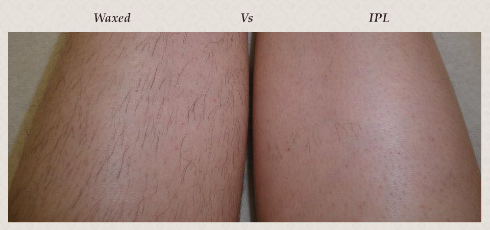 ipl_for_hair_removal._ipl_the_right_leg__wax_the_left_leg.the_result_after_4weeks._first_session_only..jpg