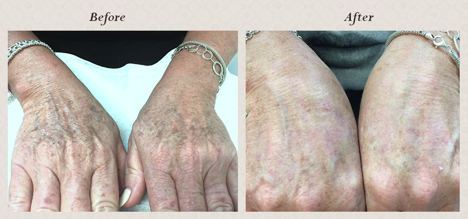 ipl_rejuvenation_on_hands_for_sunspots._the_result_in_one_treatment_before___after_photos_after_3weeks._1.jpg